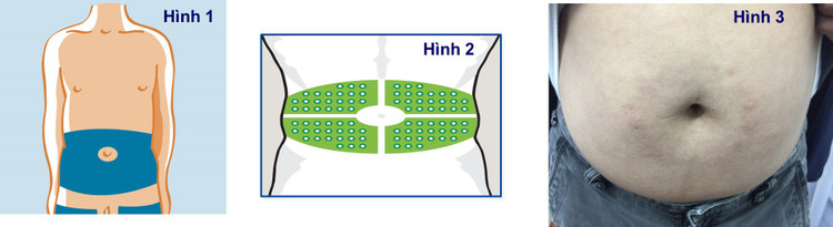 Vị trí tiêm ĐÚNG là tiêm CÁCH RỐN 3 CM HẤT TRỞ RA đến tận mạng sườn (hình 1) và phải thay đổi vị trí tiêm insulin thường xuyên (hình 2), tuy nhiên nhiều bệnh nhân không nhớ hoặc được truyền miệng nhau nên họ lại tiêm SAI vị trí thành TIÊM CÁCH RỐN 3 CM, hoặc là TIÊM QUANH RỐN (hình 3)