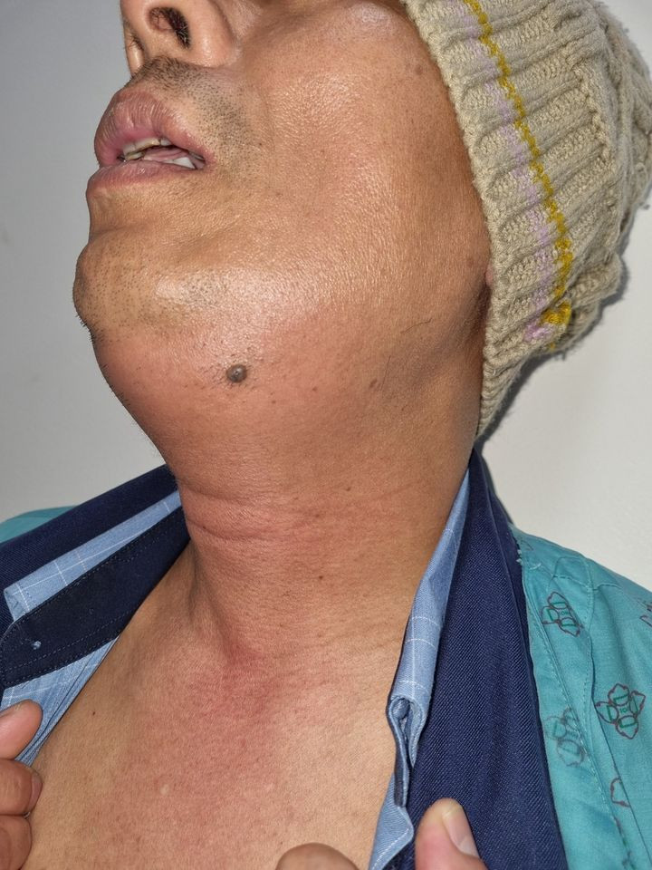 Bệnh nhân viêm tấy lan tỏa sàn miệng dịp Tết