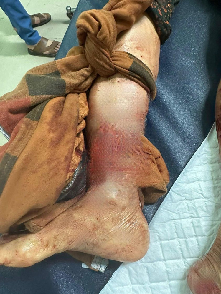 Chó nhà cắn đứt rời chân chủ nguy kịch