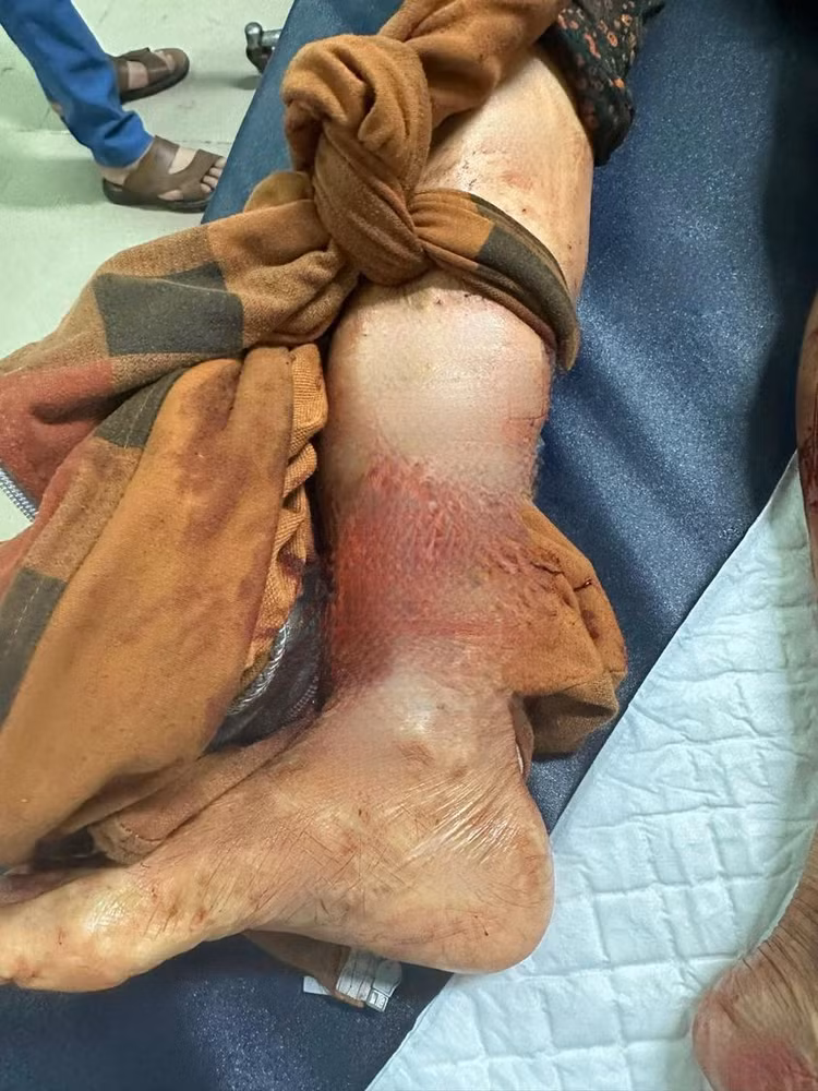 Chó nhà cắn đứt rời chân chủ nguy kịch