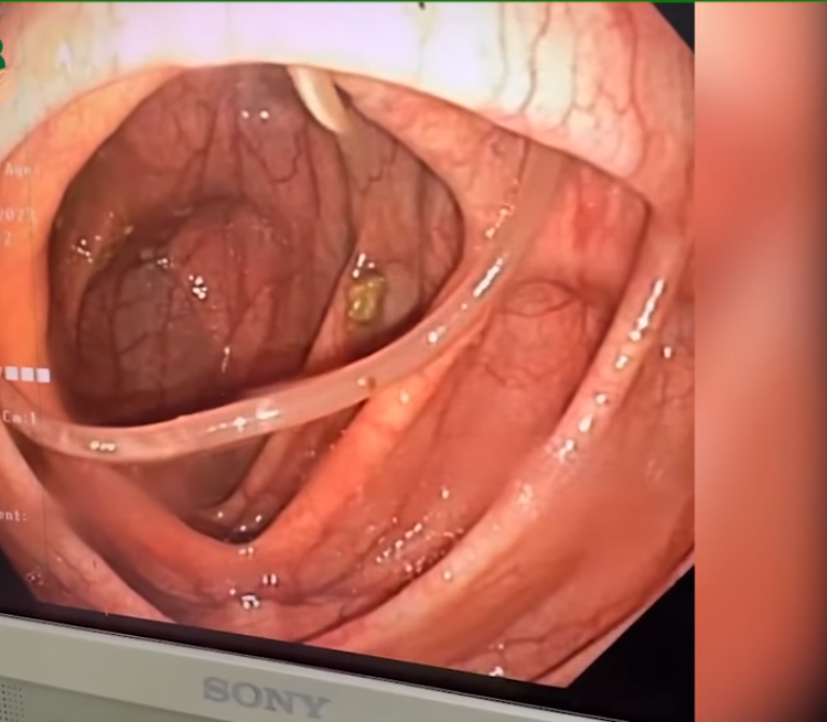 Nội soi phát hiện giun đũa 10 cm đang vận động trong đại tràng ảnh 1