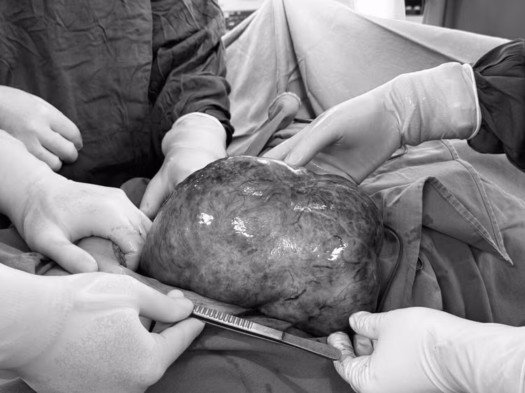 Khối u buồng trứng nặng gần 3kg được cắt bỏ thành công - Ảnh: BVCC Khối u buồng trứng nặng gần 3kg được cắt bỏ thành công - Ảnh: BVCC