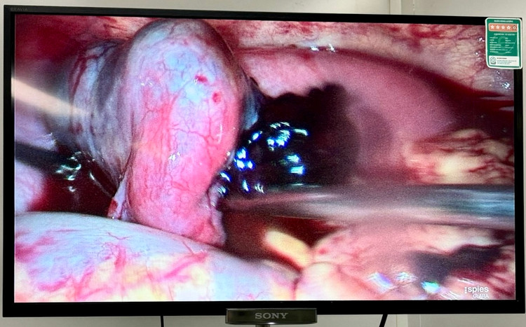 Hình ảnh khối thai ngoài tử cung ở bóng vòi tử cung có đường kính 03cm, chiều dài 05cm chuyển màu tím sẫm và đã có điểm vỡ chảy máu - Ảnh BVCC