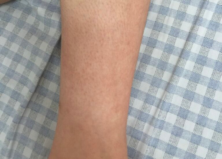 Sốt xuất huyết Ban xuất huyết trên cổ chân người bệnh - Ảnh BVCC