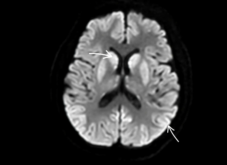 Não bệnh nhân bị tổn thương nặng, rất khó có thể hồi phục. Ảnh: BVCC.