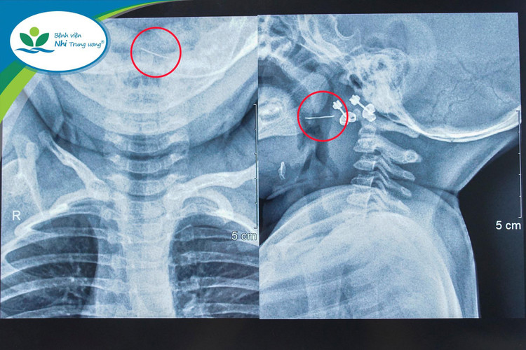 Sợi thép đâm xuyên Amidan vì lọc cháo qua rây. Sợi thép đâm xuyên Amidan vì lọc cháo qua rây.