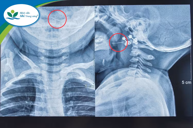 Sợi thép đâm xuyên Amidan vì lọc cháo qua rây.