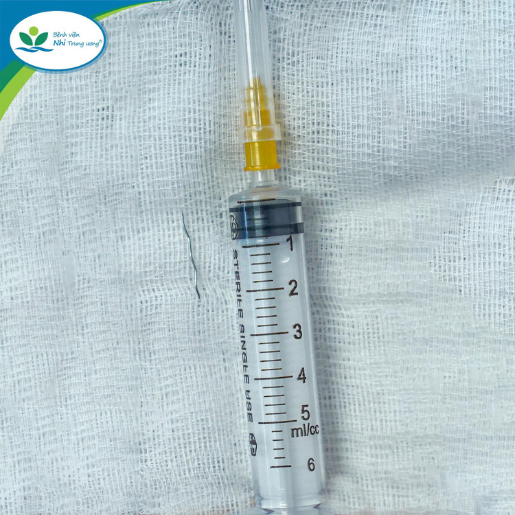 Sợi thép đâm xuyên Amidan của trẻ được lấy ra. Sợi thép đâm xuyên Amidan của trẻ được lấy ra.