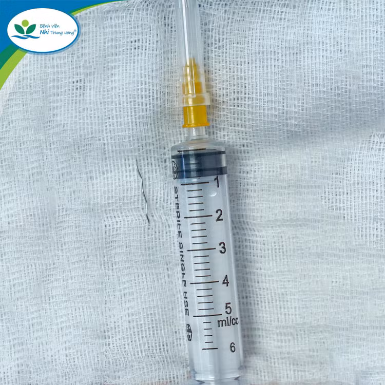 Sợi thép đâm xuyên Amidan của trẻ được lấy ra.