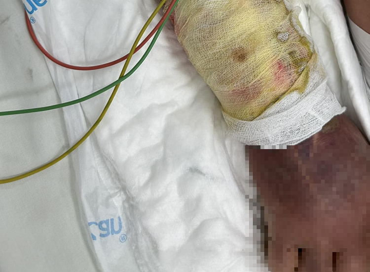 Tổn thương tay của bệnh nhân bị viêm mô tế bào