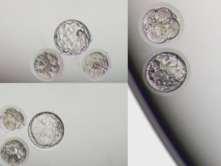 Sau thụ tinh, vợ chồng anh D. có tới 7 phôi với chất lượng khá tốt.