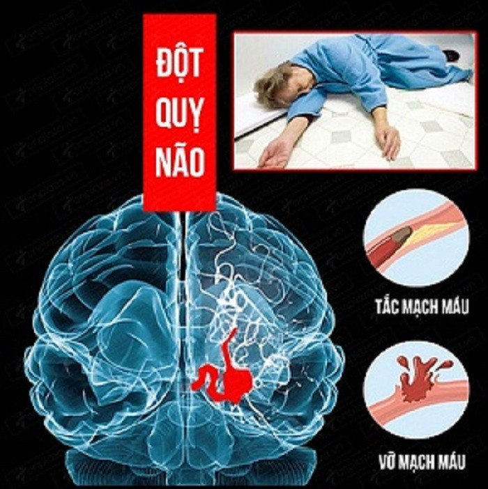 Bác sĩ chỉ rõ những quan niệm sai lầm về đột quỵ não ảnh 1