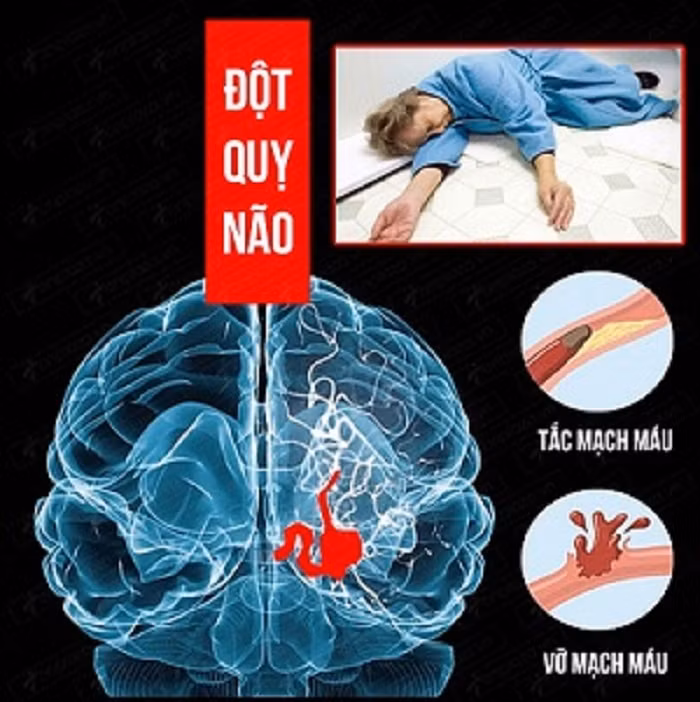 Bác sĩ chỉ rõ những quan niệm sai lầm về đột quỵ não ảnh 1