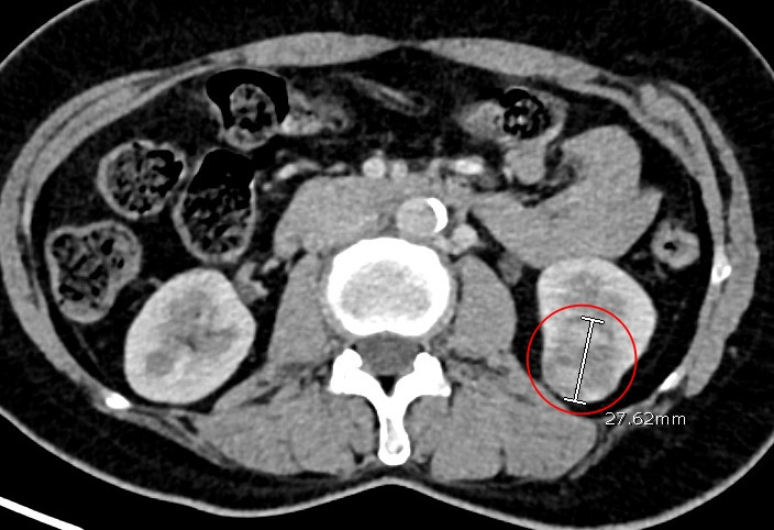 Hình ảnh khối u thận ác tính của bệnh nhân Ph. qua phim chụp cắt lớp vi tính - Ảnh BVCC