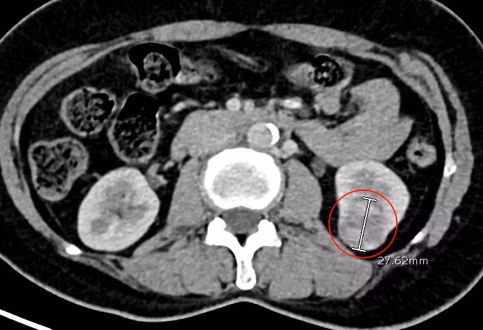 Hình ảnh khối u thận ác tính của bệnh nhân Ph. qua phim chụp cắt lớp vi tính - Ảnh BVCC