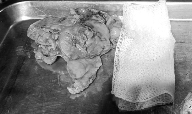 Phần thận chứa khối u và tổ chức mỡ xung quanh được nội soi lấy ra thành công - Ảnh BVCC