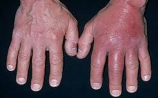 Viêm mô tế bào ở tay - Ảnh minh họa