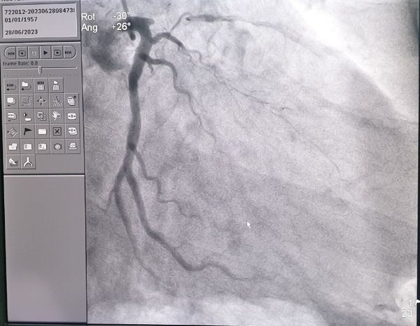 Phát hiện hẹp khít đoạn đầu động mạch liên thất trước