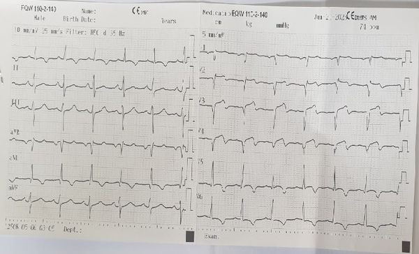 Tình trạng thiếu máu cơ tim trên điện tâm đồ