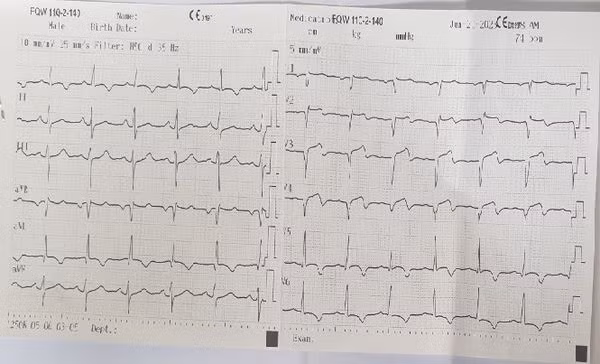 Tình trạng thiếu máu cơ tim trên điện tâm đồ
