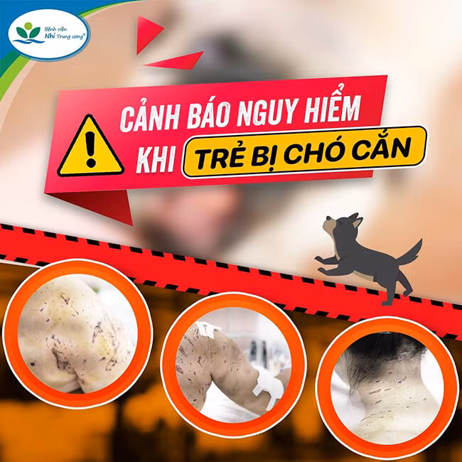 Trẻ bị 4 con chó tấn công với hàng trăm vết thương trên cơ thể