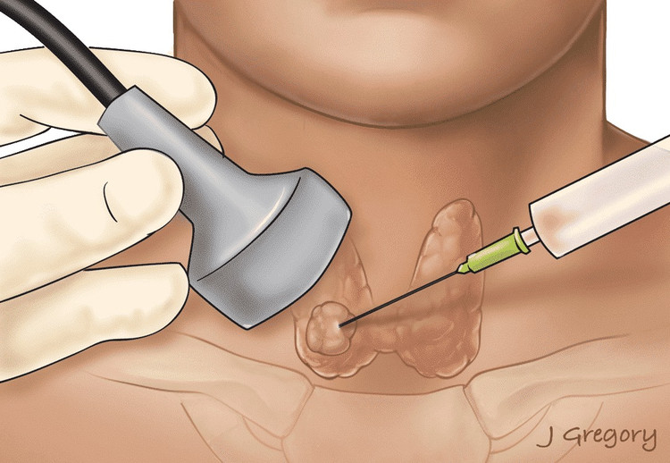 Ngưng thuốc chống đông máu khi chọc tuyến giáp có gây đột quỵ? ảnh 1