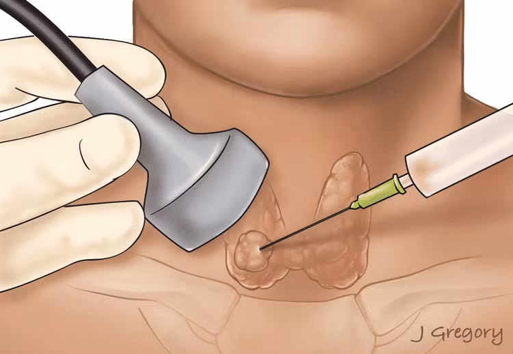 Ngưng thuốc chống đông máu khi chọc tuyến giáp có gây đột quỵ? ảnh 1