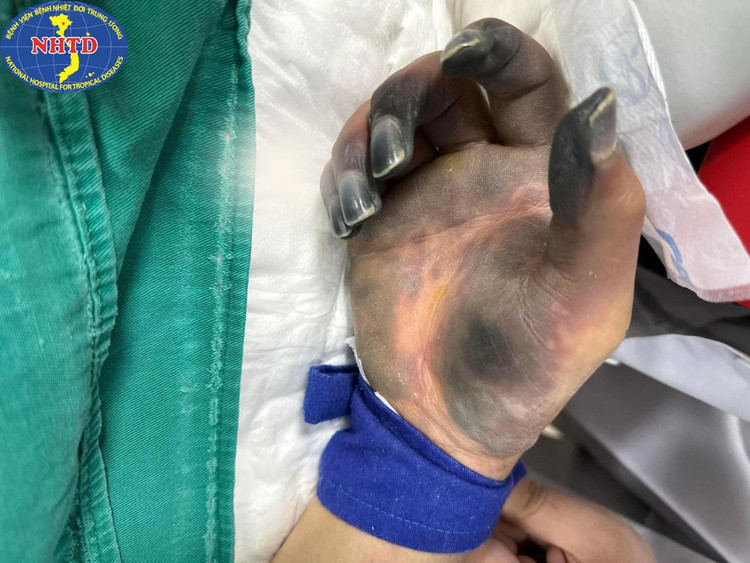 Ăn miếng dồi lợn người đàn ông bị cắt bỏ 2 chân và các ngón tay ảnh 2