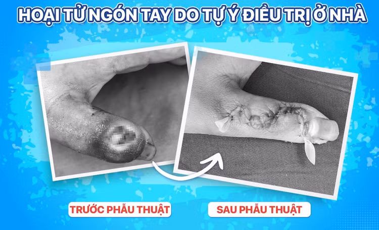 Đắp thuốc lá trị mụn trẻ 14 tuổi bị hoại tử ngón tay ảnh 1