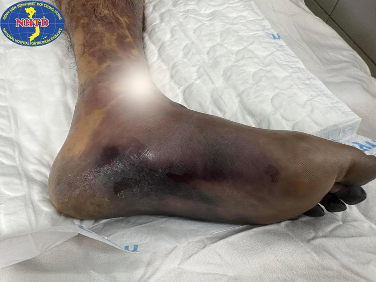 Ăn miếng dồi lợn người đàn ông bị cắt bỏ 2 chân và các ngón tay ảnh 1