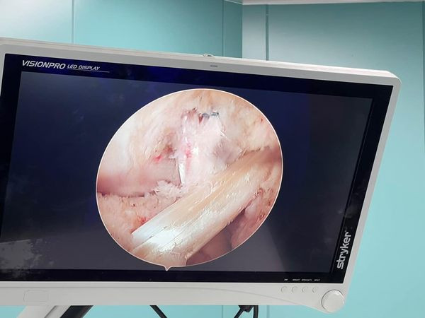 Hình ảnh tổn thương dây chằng trong nội soi - Ảnh BVCC