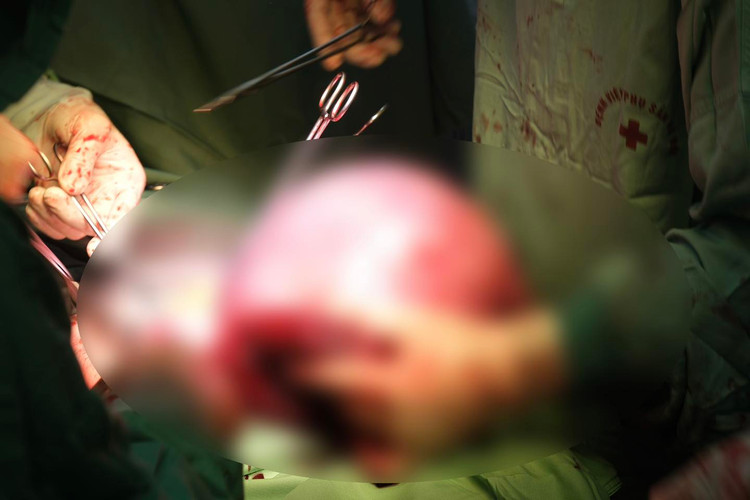 Ca phẫu thuật cấp cứu cho sản phụ - Ảnh BVCC