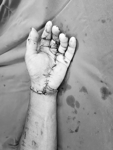 Tay bệnh nhân có tiên lượng phục hồi tốt - Ảnh BVCC