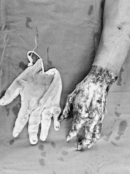 Bệnh nhân bị lột toàn bộ da tay kiểu lột găng - Ảnh BVCC