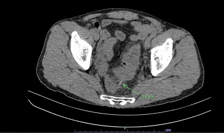 Hình ảnh chụp cắt lớp vi tính cho thấy dị vật đâm thủng đại tràng người bệnh