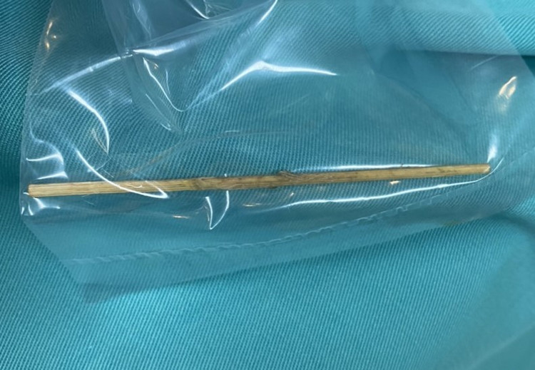 Dị vật là chiếc tăm tre dài 10cm sau khi được lấy ra ngoài