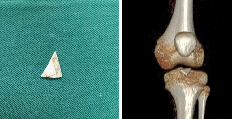 Mảnh sành được phát hiện trong khớp gối của bệnh nhi Mảnh sành được phát hiện trong khớp gối của bệnh nhi