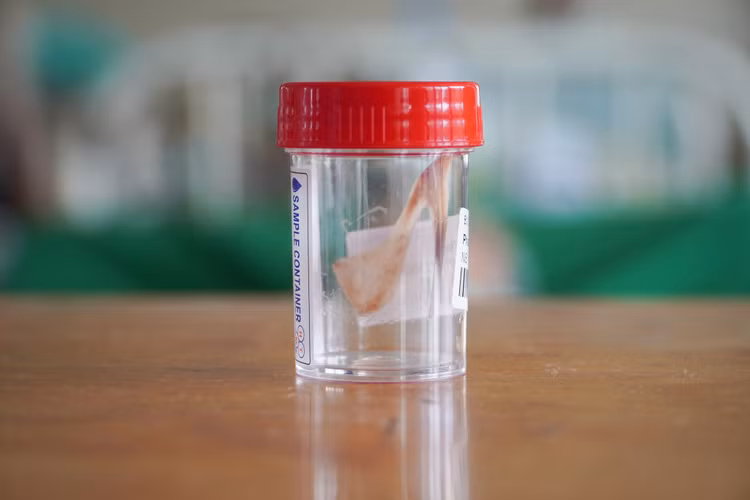 Xương hóc được lấy ra