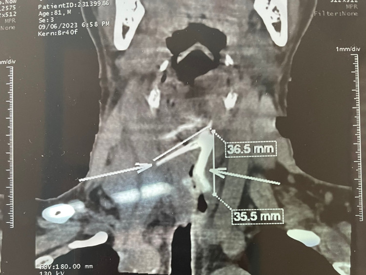 Hình ảnh xương hóc trên phim chụp