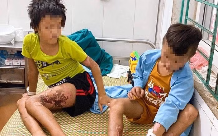 2 bé ở Hà Giang bị bỏng nặng do chú họ hành hạ