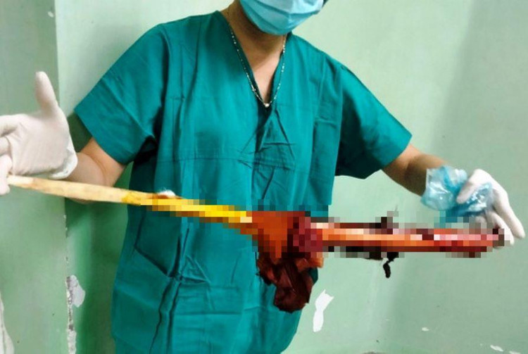 Cận cảnh cây gỗ đâm xuyên ngực bệnh nhân.