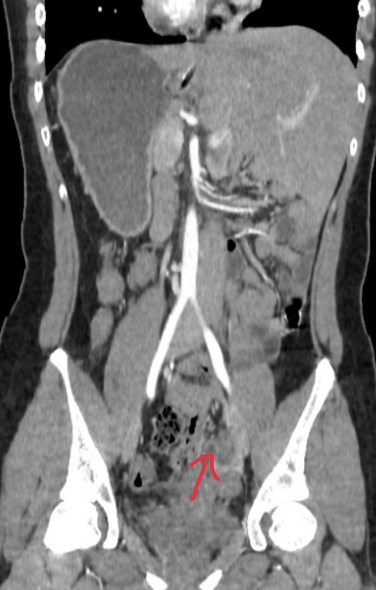 Hình ảnh ruột thừa viêm ở bệnh nhân phủ tạng đảo ngược - Ảnh BVCC