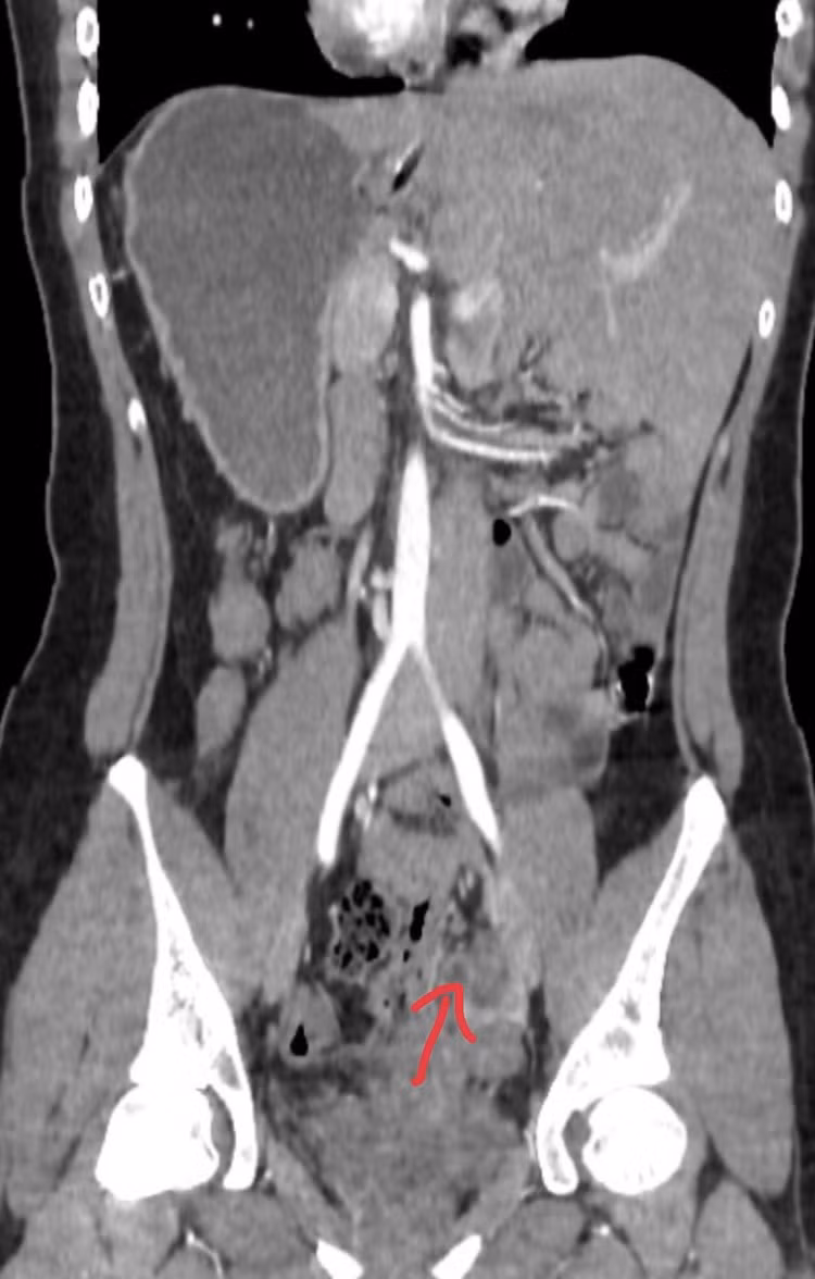 Hình ảnh ruột thừa viêm ở bệnh nhân phủ tạng đảo ngược - Ảnh BVCC