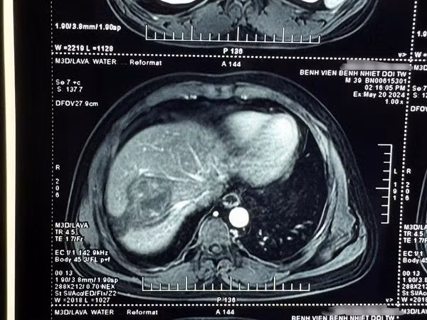 Ổ sán tạo thành u trên phim chụp - Ảnh BVCC
