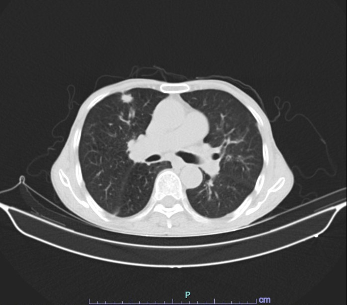 Hình ảnh kết quả chụp cắt lớp vi tính của người bệnh Đào Đình Ngưng - Ảnh BVCC