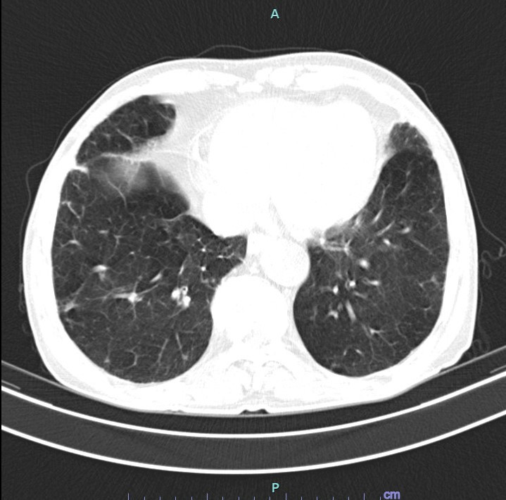 Hình ảnh kết quả chụp cắt lớp vi tính của người bệnh Đào Văn Lập - Ảnh BVCC