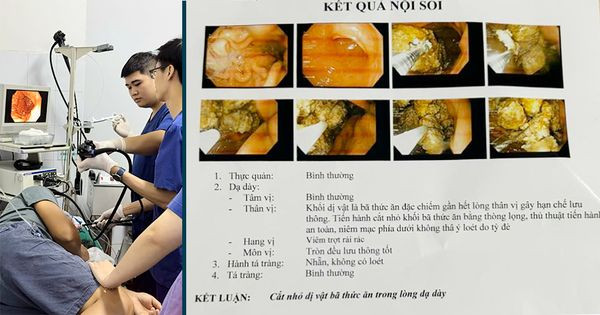 Bệnh nhân bị khối dị vật thức ăn nút dạ dày - Ảnh BVCC