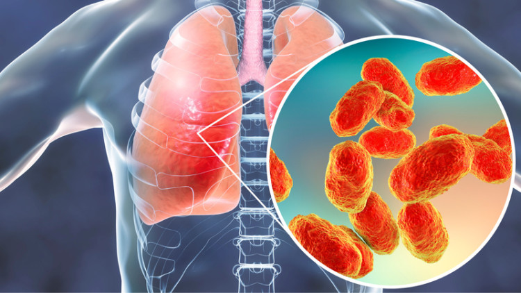 Sốt và ho ra máu do vi khuẩn tại Nga - Ảnh minh họa