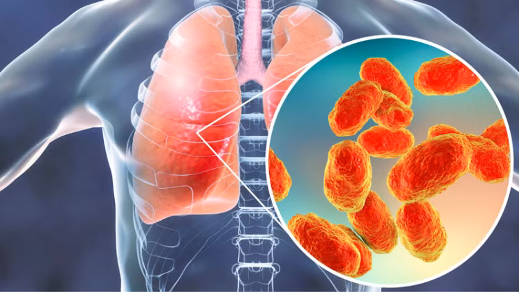 Mycoplasma pneumoniae chính là tác nhân nhận được sự quan tâm lớn nhất bởi vì tỷ lệ gây viêm phổi cộng đồng - Ảnh minh họa