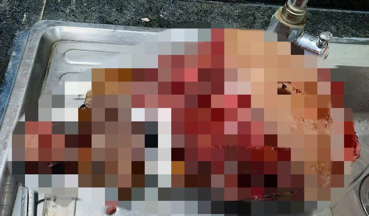 Hình ảnh khối u nặng 3,5kg - Ảnh BVCC